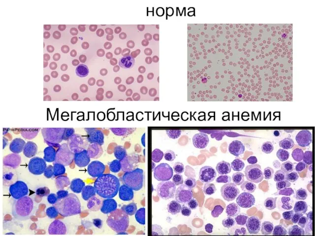 Мегалобластическая анемия норма