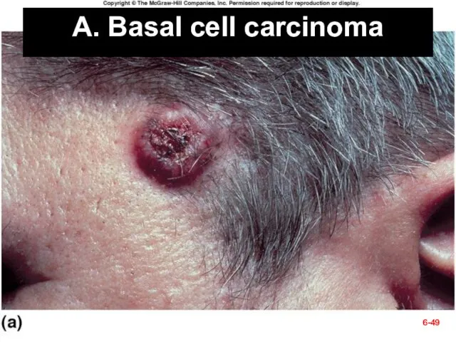 Fig. 6.12a A. Basal cell carcinoma 6-