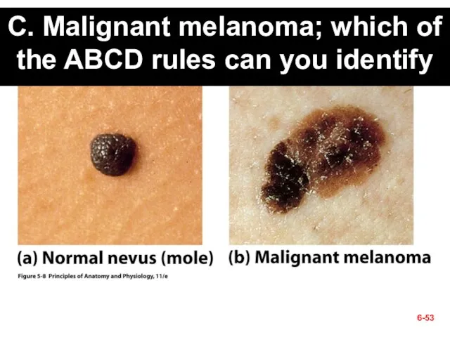 C. Malignant melanoma; which of the ABCD rules can you identify 6-