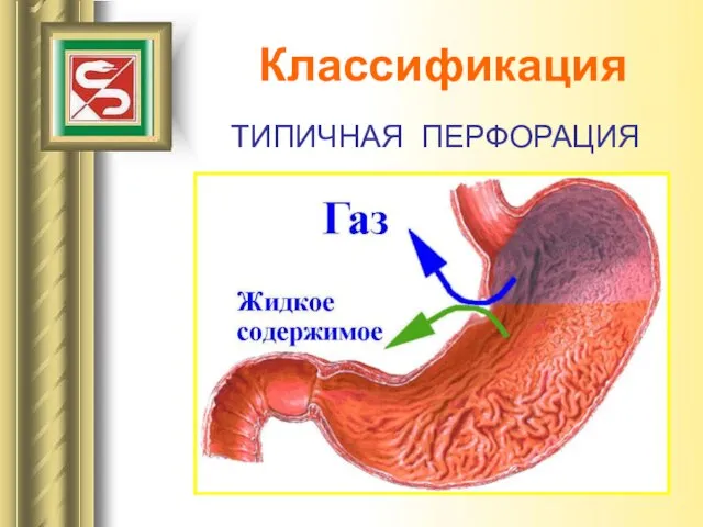 Классификация ТИПИЧНАЯ ПЕРФОРАЦИЯ