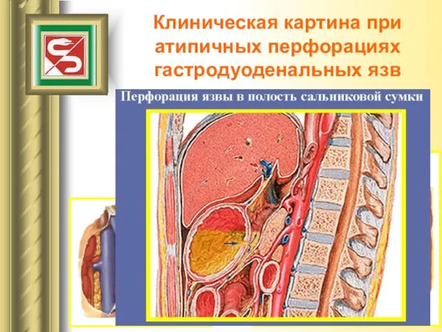 Клиническая картина при атипичных перфорациях гастродуоденальных язв