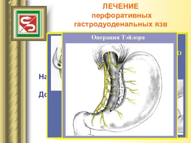 ЛЕЧЕНИЕ перфоративных гастродуоденальных язв Хирургическое лечение Наркоз – эндотрахеальный с ИВЛ. Доступ – верхняя срединная лапаротомия.