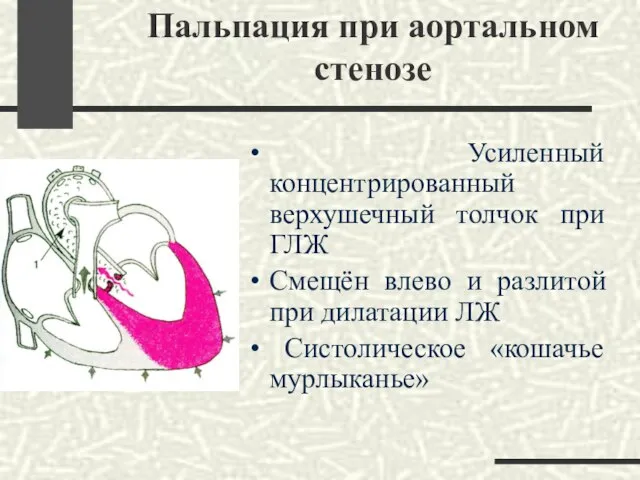 Пальпация при аортальном стенозе Усиленный концентрированный верхушечный толчок при ГЛЖ Смещён