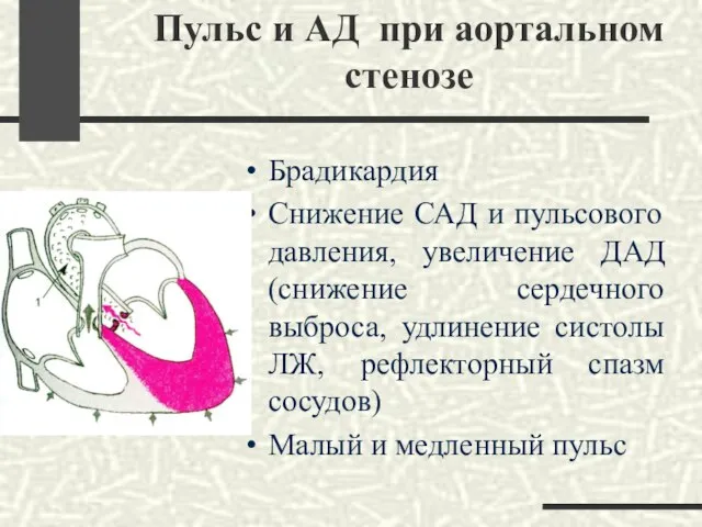 Пульс и АД при аортальном стенозе Брадикардия Снижение САД и пульсового