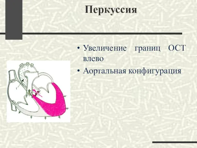 Перкуссия Увеличение границ ОСТ влево Аортальная конфигурация