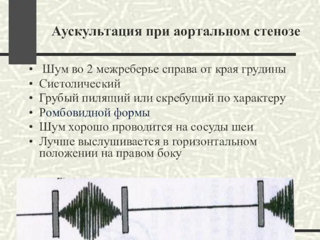 Аускультация при аортальном стенозе Шум во 2 межреберье справа от края