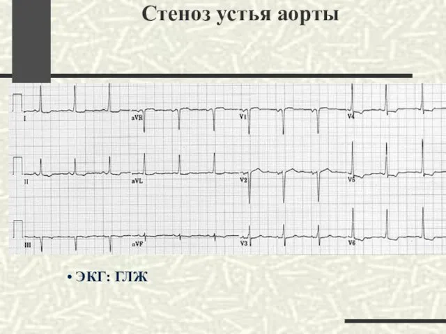 Стеноз устья аорты ЭКГ: ГЛЖ