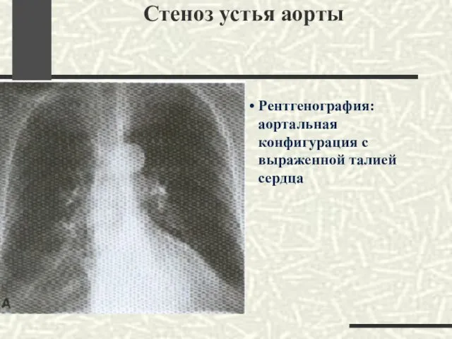 Стеноз устья аорты Рентгенография: аортальная конфигурация с выраженной талией сердца