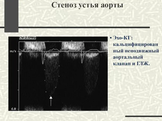 Стеноз устья аорты Эхо-КГ: кальцифицированный неподвижный аортальный клапан и ГЛЖ.