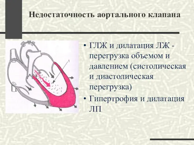 Недостаточность аортального клапана ГЛЖ и дилатация ЛЖ - перегрузка объемом и