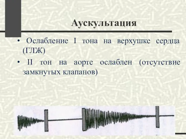 Аускультация Ослабление I тона на верхушке сердца (ГЛЖ) II тон на аорте ослаблен (отсутствие замкнутых клапанов)