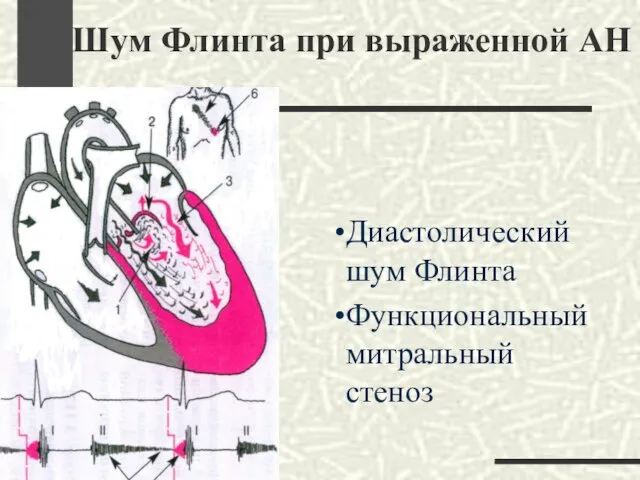 Шум Флинта при выраженной АН Диастолический шум Флинта Функциональный митральный стеноз