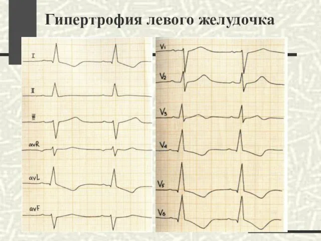 Гипертрофия левого желудочка