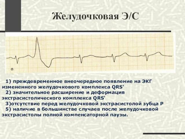 Желудочковая Э/С 1) преждевременное внеочередное появление на ЭКГ измененного желудочкового комплекса