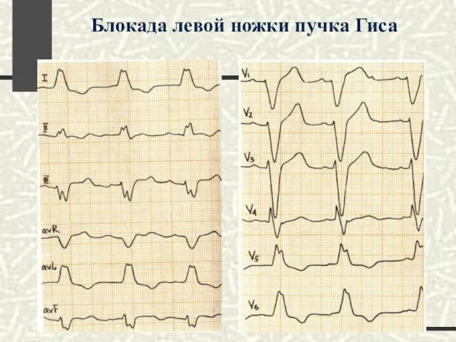 Блокада левой ножки пучка Гиса