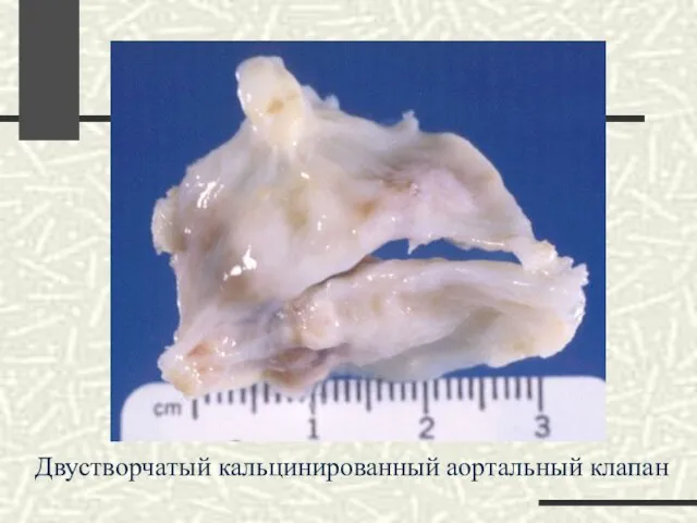 Двустворчатый кальцинированный аортальный клапан