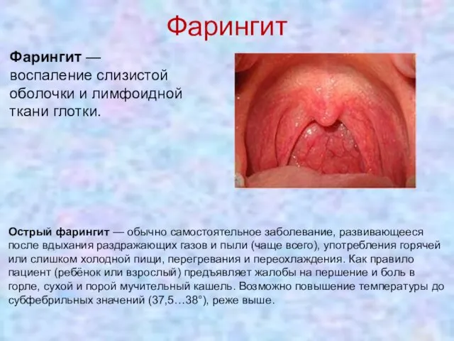 Фарингит Фарингит — воспаление слизистой оболочки и лимфоидной ткани глотки. Острый