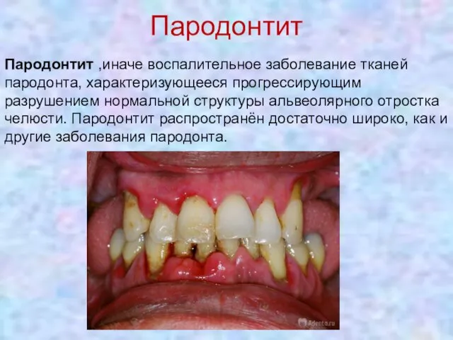 Пародонтит Пародонтит ,иначе воспалительное заболевание тканей пародонта, характеризующееся прогрессирующим разрушением нормальной