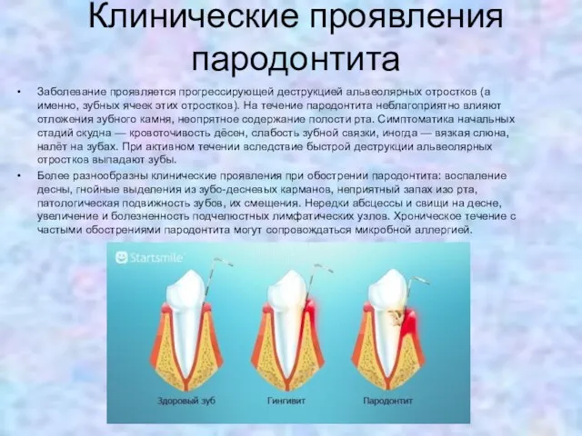 Клинические проявления пародонтита Заболевание проявляется прогрессирующей деструкцией альвеолярных отростков (а именно,