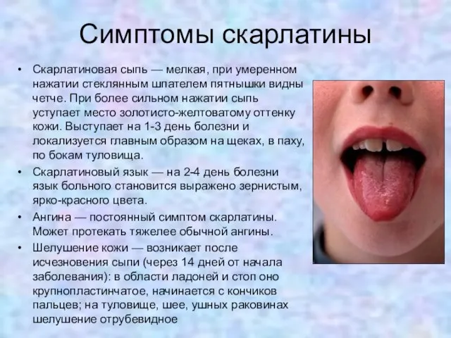 Симптомы скарлатины Скарлатиновая сыпь — мелкая, при умеренном нажатии стеклянным шпателем