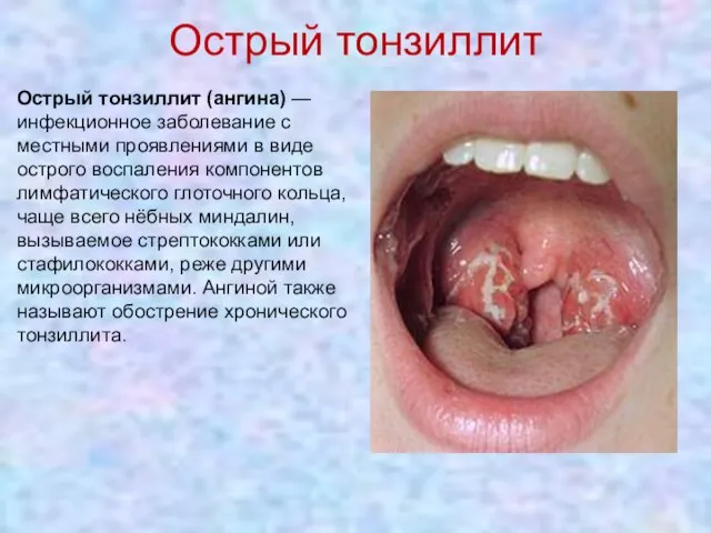 Острый тонзиллит Острый тонзиллит (ангина) — инфекционное заболевание с местными проявлениями