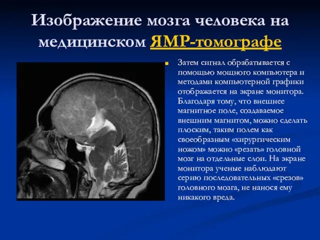 Изображение мозга человека на медицинском ЯМР-томографе Затем сигнал обрабатывается с помощью