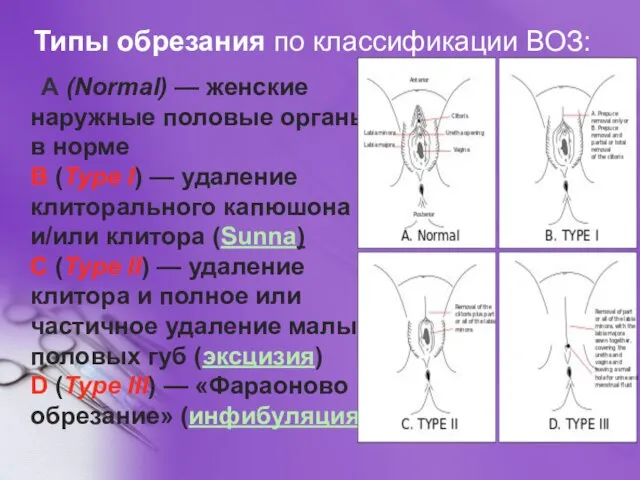 Типы обрезания по классификации ВОЗ: A (Normal) — женские наружные половые