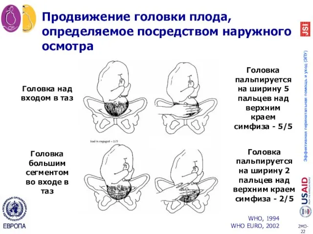 Продвижение головки плода, определяемое посредством наружного осмотра Головка над входом в