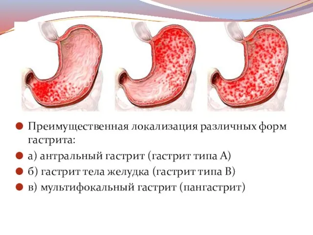 Преимущественная локализация различных форм гастрита: а) антральный гастрит (гастрит типа А)