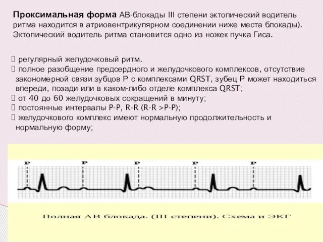 Проксимальная форма АВ-блокады III степени эктопический водитель ритма находится в атриовентрикулярном