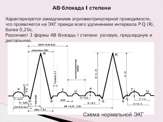 АВ-блокада I степени Характеризуется замедлением атриовентрикулярной проводимости, что проявляется на ЭКГ
