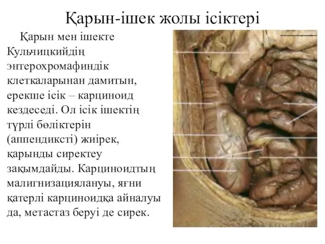 Қарын-ішек жолы ісіктері Қарын мен ішекте Кульчицкийдің энтерохромафиндік клеткаларынан дамитын, ерекше