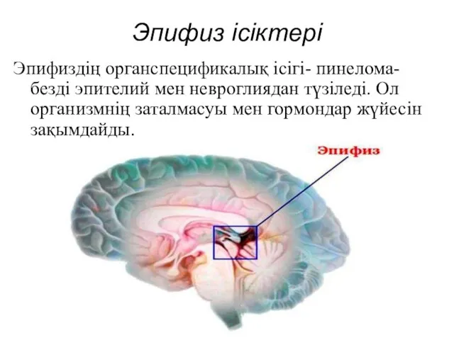 Эпифиз ісіктері Эпифиздің органспецификалық ісігі- пинелома- безді эпителий мен невроглиядан түзіледі.