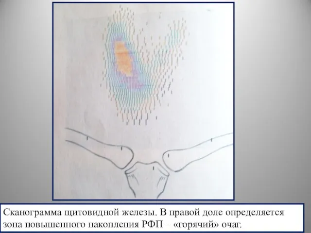 Сканограмма щитовидной железы. В правой доле определяется зона повышенного накопления РФП – «горячий» очаг.