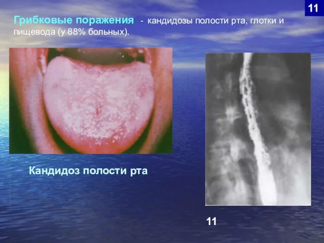 11 Грибковые поражения - кандидозы полости рта, глотки и пищевода (у
