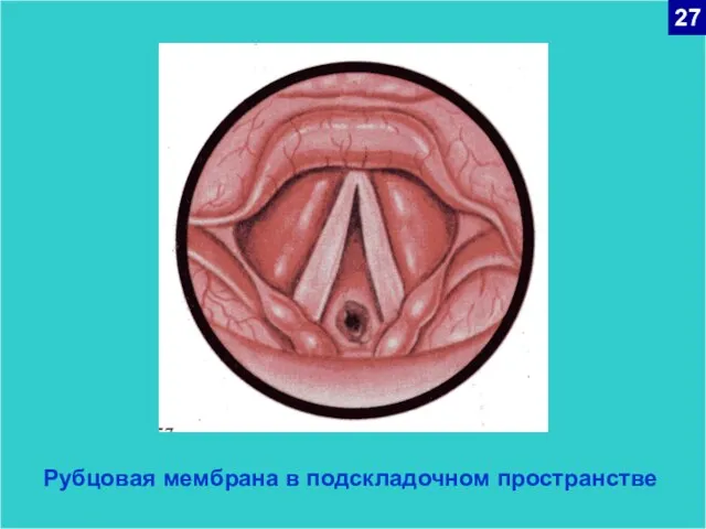 Рубцовая мембрана в подскладочном пространстве 27