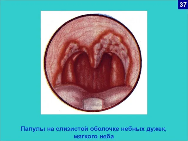 Папулы на слизистой оболочке небных дужек, мягкого неба 37