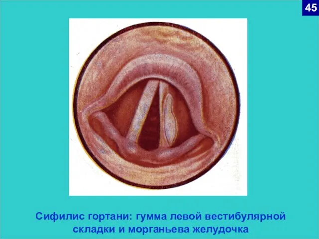 Сифилис гортани: гумма левой вестибулярной складки и морганьева желудочка 45
