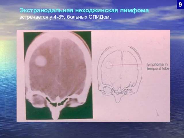 9 Экстранодальная неходжинская лимфома встречается у 4-8% больных СПИДом.