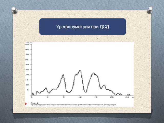 . Урофлоуметрия при ДСД