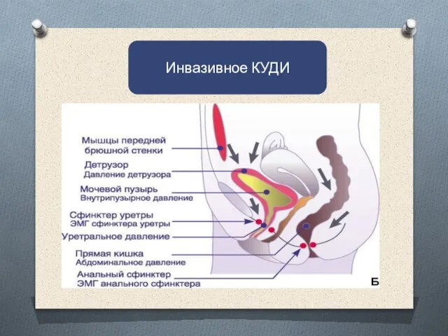 . Инвазивное КУДИ