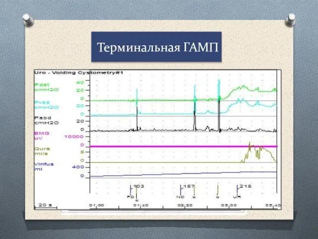 Терминальная ГАМП