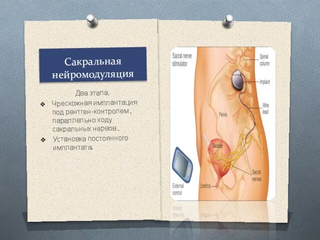 Сакральная нейромодуляция Два этапа. Чрескожная имплантация под рентген-контролем ,параллельно ходу сакральных нервов . Установка постоянного имплантата.