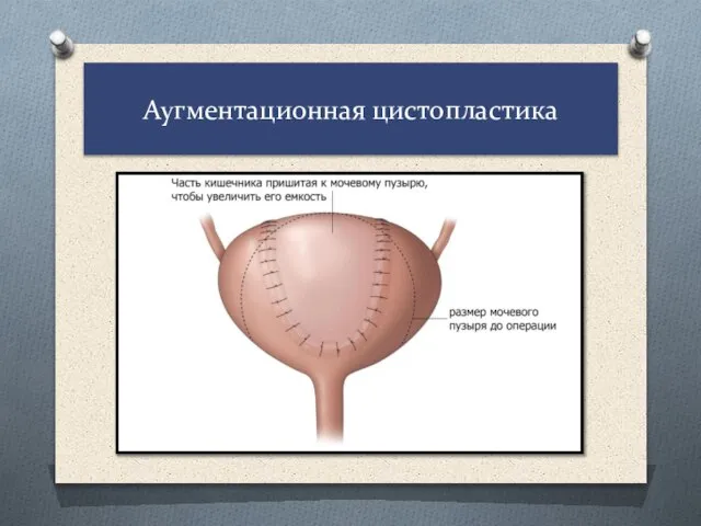 Аугментационная цистопластика