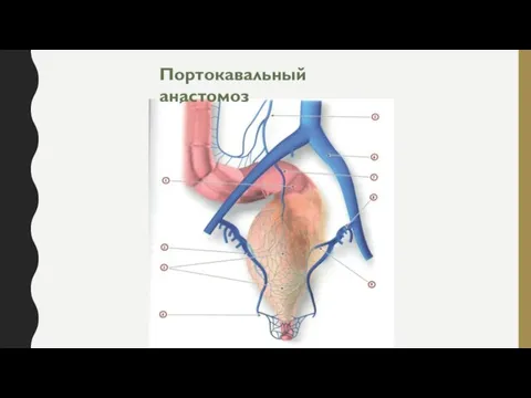 Портокавальный анастомоз