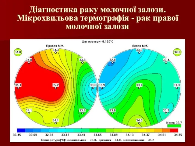 Діагностика раку молочної залози. Мікрохвильова термографія - рак правої молочної залози