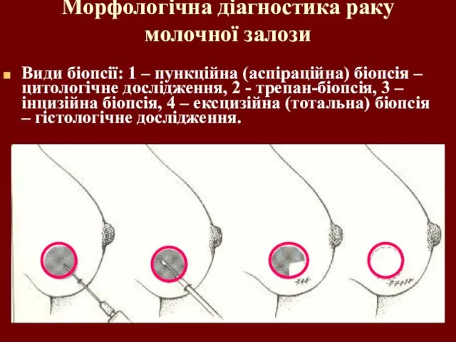 Морфологічна діагностика раку молочної залози Види біопсії: 1 – пункційна (аспіраційна)