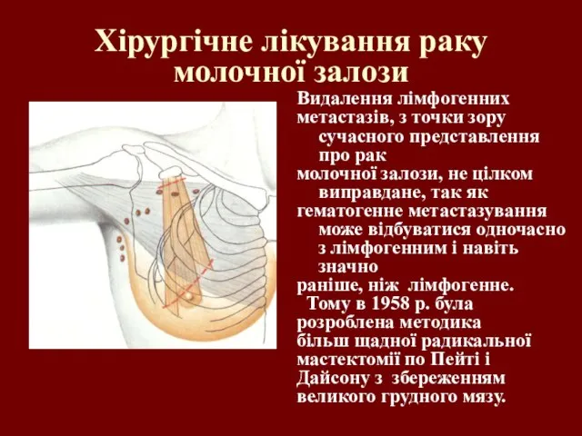 Хірургічне лікування раку молочної залози Видалення лімфогенних метастазів, з точки зору