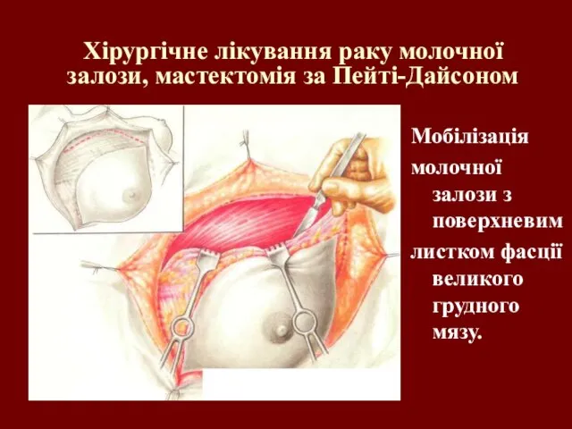 Хірургічне лікування раку молочної залози, мастектомія за Пейті-Дайсоном Мобілізація молочної залози