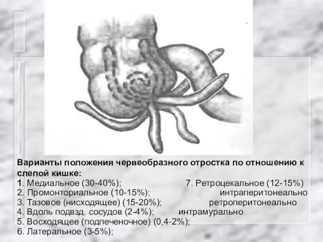 Варианты положения червеобразного отростка по отношению к слепой кишке: 1. Медиальное